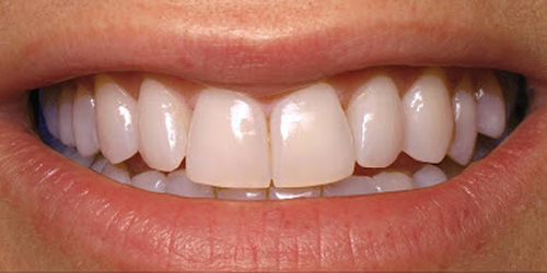 atlanticmediBleaching