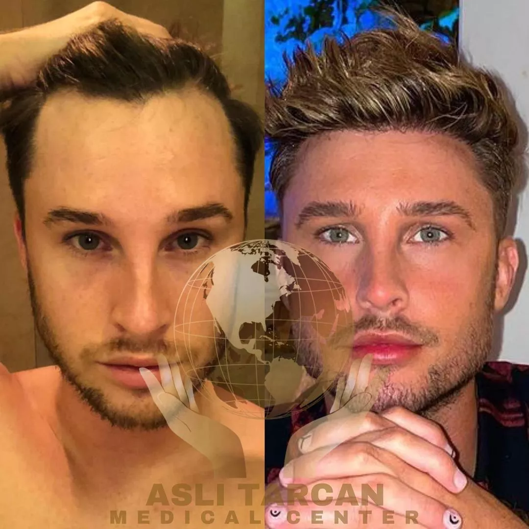 ATLANTICMEDI Hair Transplant