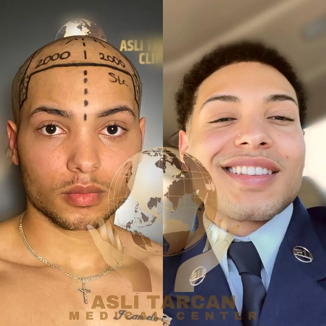 ATLANTICMEDI Hair Transplant